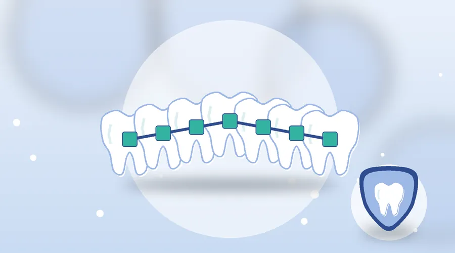 Limpieza con brackets: evitar manchas, manchas blancas y encías hinchadas